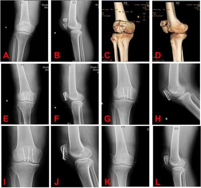 Clinical application of Kirschner wires combined with 5-Ethibond fixation for patella fractures